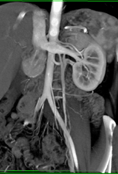 Prominent Gonadal Vein on Left - CTisus CT Scan