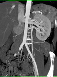 See Relationship of Renal Vein and Aorta on MIP Vs VRT - CTisus CT Scan