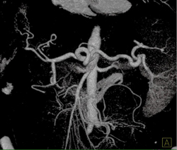 Celiac Axis - CTisus CT Scan