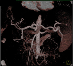 Celiac Axis VRT Vs MIP - CTisus CT Scan