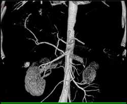 Replaced Right Hepatic Aa Off SMA - CTisus CT Scan