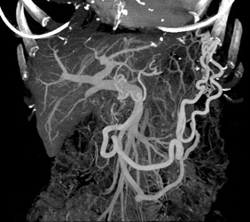 Occluded Splenic Vein With Collaterals - CTisus CT Scan