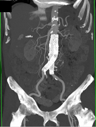 Endovascular Stent With Leak - CTisus CT Scan