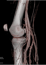 Patent Popliteal Artery Aneurysm - CTisus CT Scan