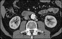 Ulcer in Aorta - CTisus CT Scan