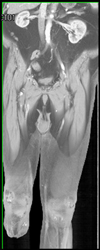 Peripheral Vascular Disease With Occluded Stent on the Right - CTisus CT Scan