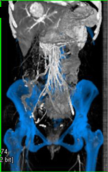 Incidental Focal Nodular Hyperplasia (FNH) in Liver and Occluded Right Iliac AA - CTisus CT Scan