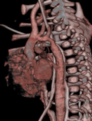 Coarctation of the Aorta-coa - CTisus CT Scan