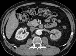 Aortic Dissection With Decreased Enhancement of the Left Kidney - CTisus CT Scan