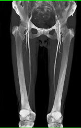 Arteriovenous (AV) Fistulae in the Thigh - CTisus CT Scan