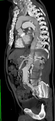 Aortic Dissection - CTisus CT Scan