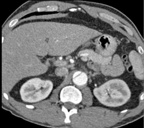 Aortic Dissection - CTisus CT Scan