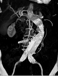 Endovascular Stent - CTisus CT Scan