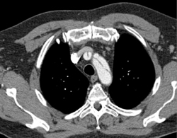 Aortic Dissection Into the Arch Vessels - CTisus CT Scan