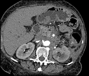 Lymphoma Encases the Renal Artery - CTisus CT Scan