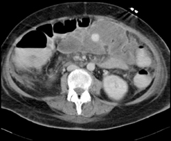 Pseudoaneurysm - CTisus CT Scan