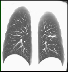 Pulmonary Arteries - CTisus CT Scan