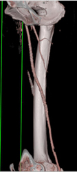 Diseased Popliteal Artery - CTisus CT Scan