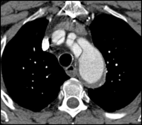 Type A Dissection - CTisus CT Scan