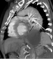 Type A Dissection - CTisus CT Scan