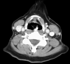 Pseudo clot in Jugular Vein - CTisus CT Scan