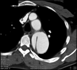 Aortic Dissection - CTisus CT Scan