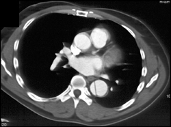 Aortic Dissection - CTisus CT Scan