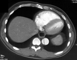 Aortic Dissection - CTisus CT Scan