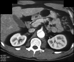 Aortic Dissection - CTisus CT Scan