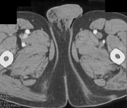 Aortic Dissection - CTisus CT Scan