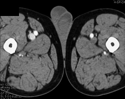 Arteriovenous (AV) Fistulae in Right Thigh - CTisus CT Scan