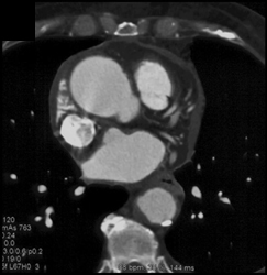 Aortic Aneurysm - CTisus CT Scan