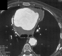 Aortic Aneurysm - CTisus CT Scan