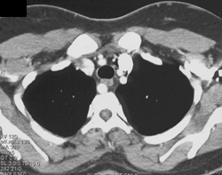 Abbenant Right Subclavian Artery - CTisus CT Scan