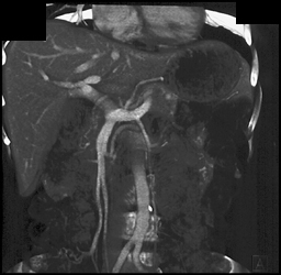 Patent Portal Vein - CTisus CT Scan