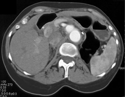 SMA Aneurysm - CTisus CT Scan