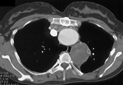 Aorta Graft - CTisus CT Scan