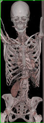 SMA Aneurysms in Loeys-dietz Syndrome - CTisus CT Scan