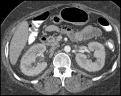 Right Renal Vein Thrombosis (RVT) - CTisus CT Scan