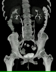 Normal Flow - CTisus CT Scan