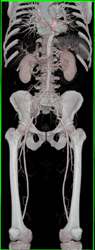 Focal External Iliac Aa Dissection - CTisus CT Scan