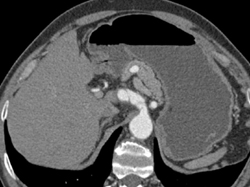 Dissection Involves Iliac Aa - CTisus CT Scan