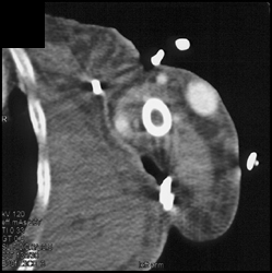 Dialysis Fistulae-fistulae in ?? - CTisus CT Scan