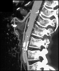 Superior Mesenteric Artery (SMA) Stenosis - CTisus CT Scan