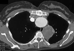 Aneurysm Desc Aorta - CTisus CT Scan