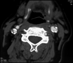 Plaque in Carotid Aa - CTisus CT Scan