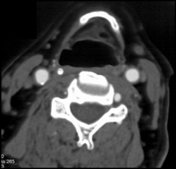 Plaque Around Right Carotid Artery - CTisus CT Scan