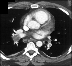 Pulmonary Embolism (PE) and Left Femoral Vein Deep Vein Thrombosis (DVT) - CTisus CT Scan