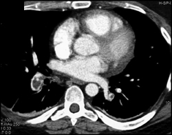 Pulmonary Embolism (PE) and Iliac Vein Thrombosis - CTisus CT Scan