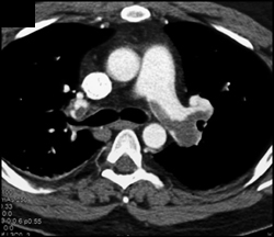 Saddle Embolism - CTisus CT Scan